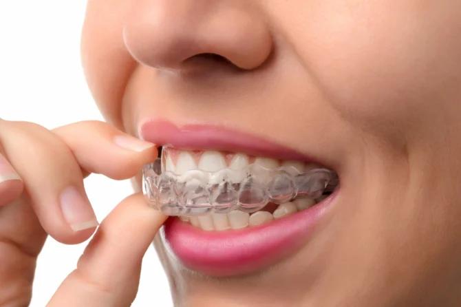 Retainer: perché è essenziale per mantenere i denti dritti