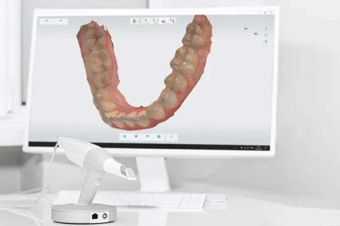 Scansione digitale 3D: perché è migliore delle impronte tradizionali