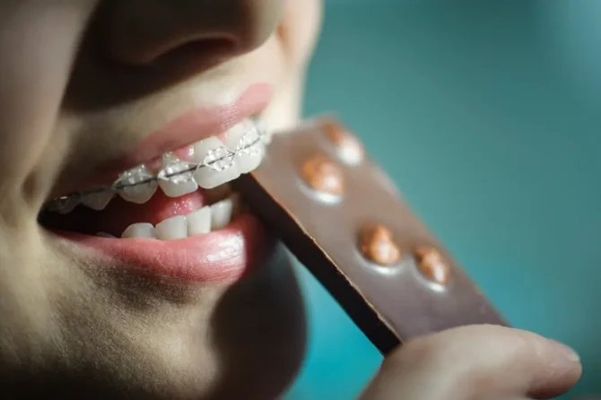 Alimenti vietati con l'apparecchio: cosa non mangiare durante il trattamento