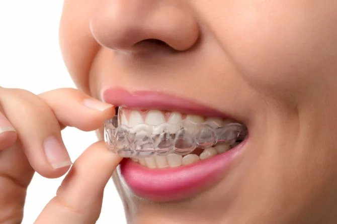 Retainer: perché è essenziale per mantenere i denti dritti