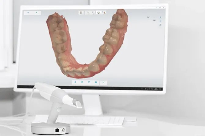 Scansione digitale 3D: perché è migliore delle impronte tradizionali