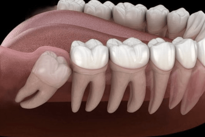 Perché i denti anteriori si spostano con il tempo? Sfatiamo un mito