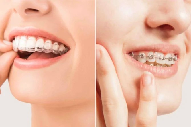 Allineamento dentale: differenza tra apparecchio tradizionale, apparecchio estetico e allineatori trasparenti